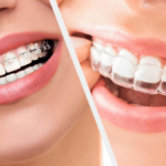 traitement orthodontique